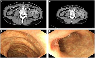 Case report and literature review: Laparoscopic extended right hemicolectomy for a 55-year-old patient with idiopathic mesenteric phlebosclerosis